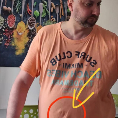Alkesz Beszarimi pálcika karokkal ès kifelé növő köldökkel