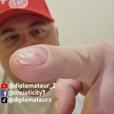 Mc isti eldeformálòdott (valòszínűleg beteg) körme