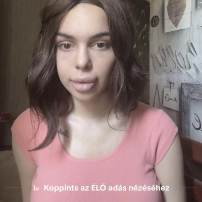 Szétműtött parókás Zsebi torz feje begyógyszerezve