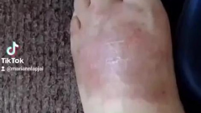Bariadd házilag gyógykezeli a páros ujjú patáját